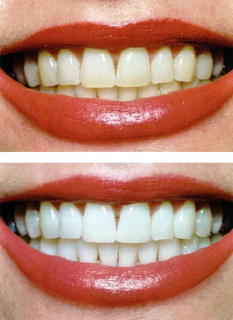 25106 foods for white teeth