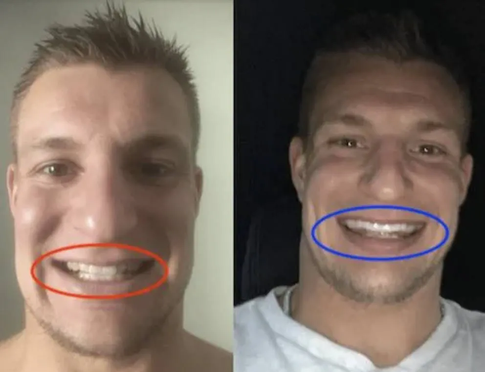 25106 in office teeth whitening