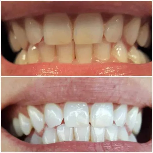 25106 teeth whitening strips