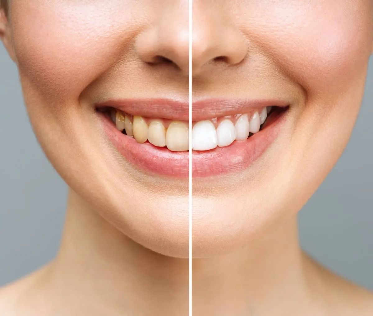 25108 teeth whitening st louis diet