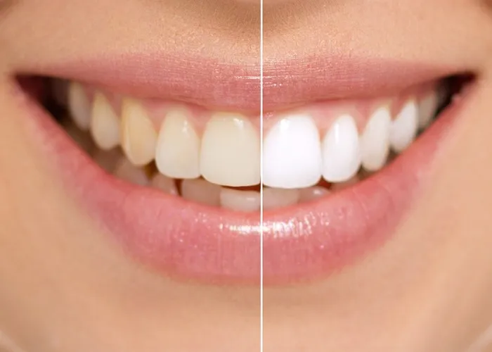 25111 sensitive teeth whitening 1