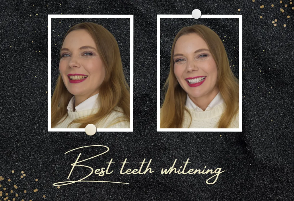 /img/25112-teeth-whitening-product.webp