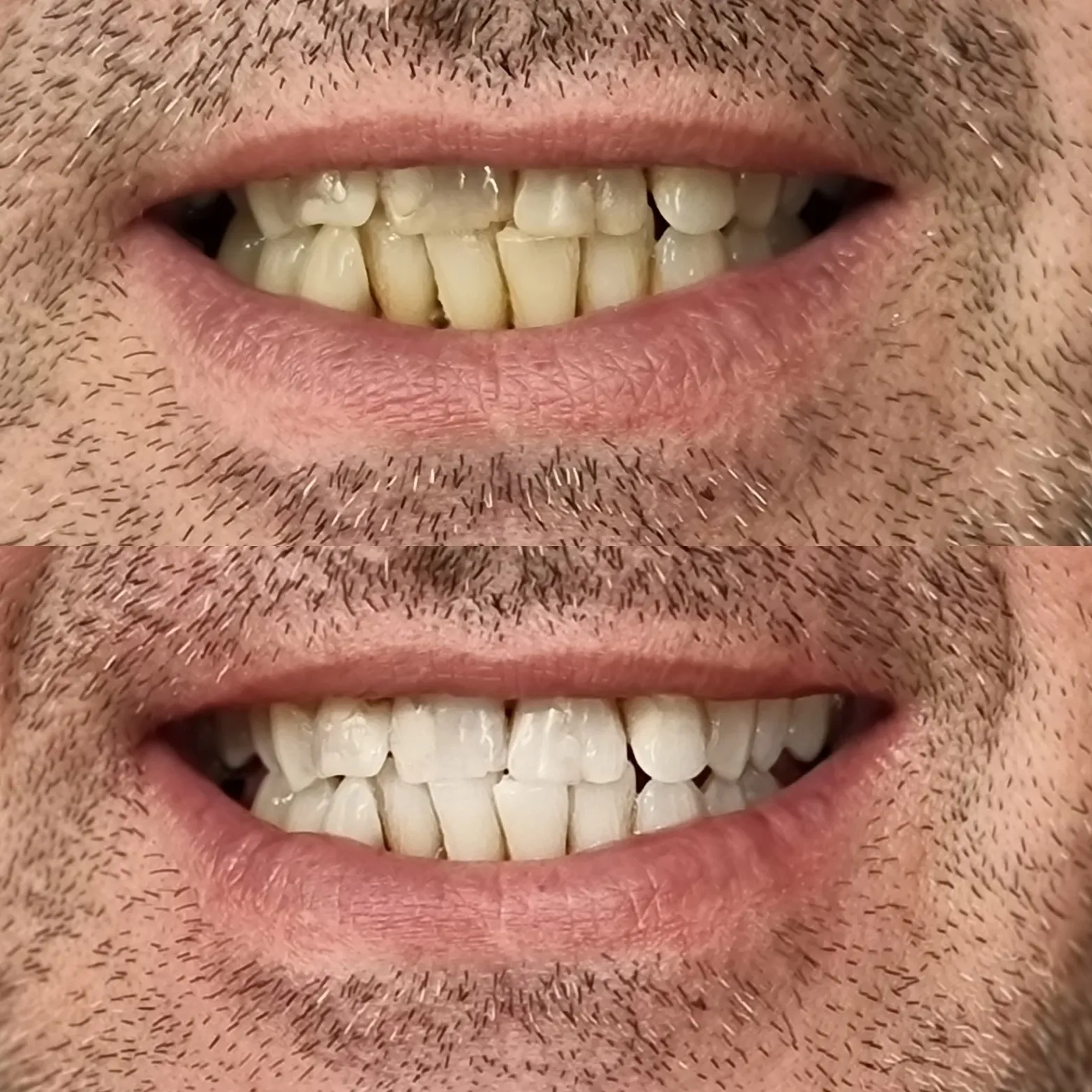 25114 professional teeth whitening