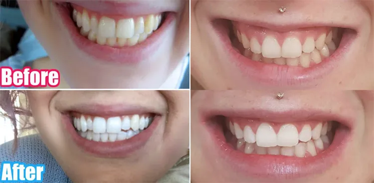25118 crest whitening strips