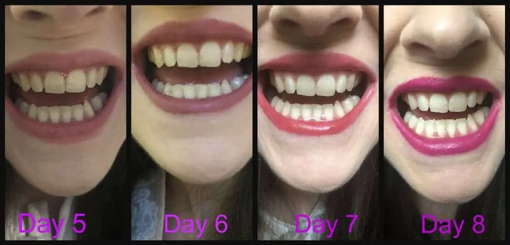 25118 tooth enamel damage