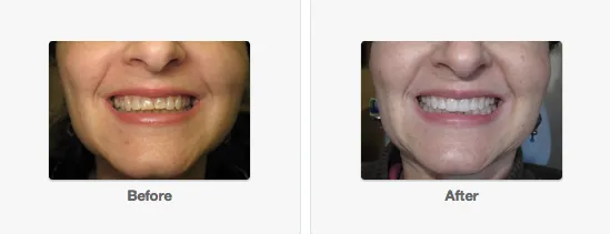 25119 beverly hills teeth whitening before after