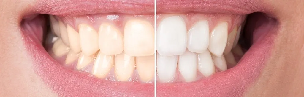 25119 teeth whitening confidence