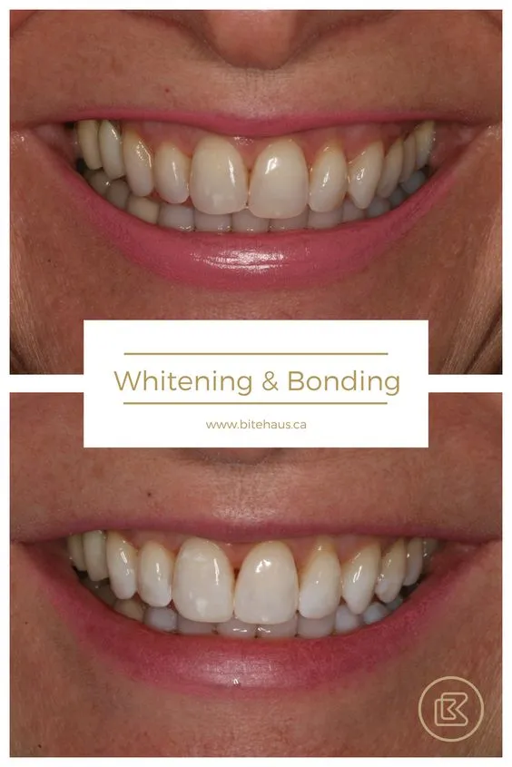 25120 at home teeth whitening kit