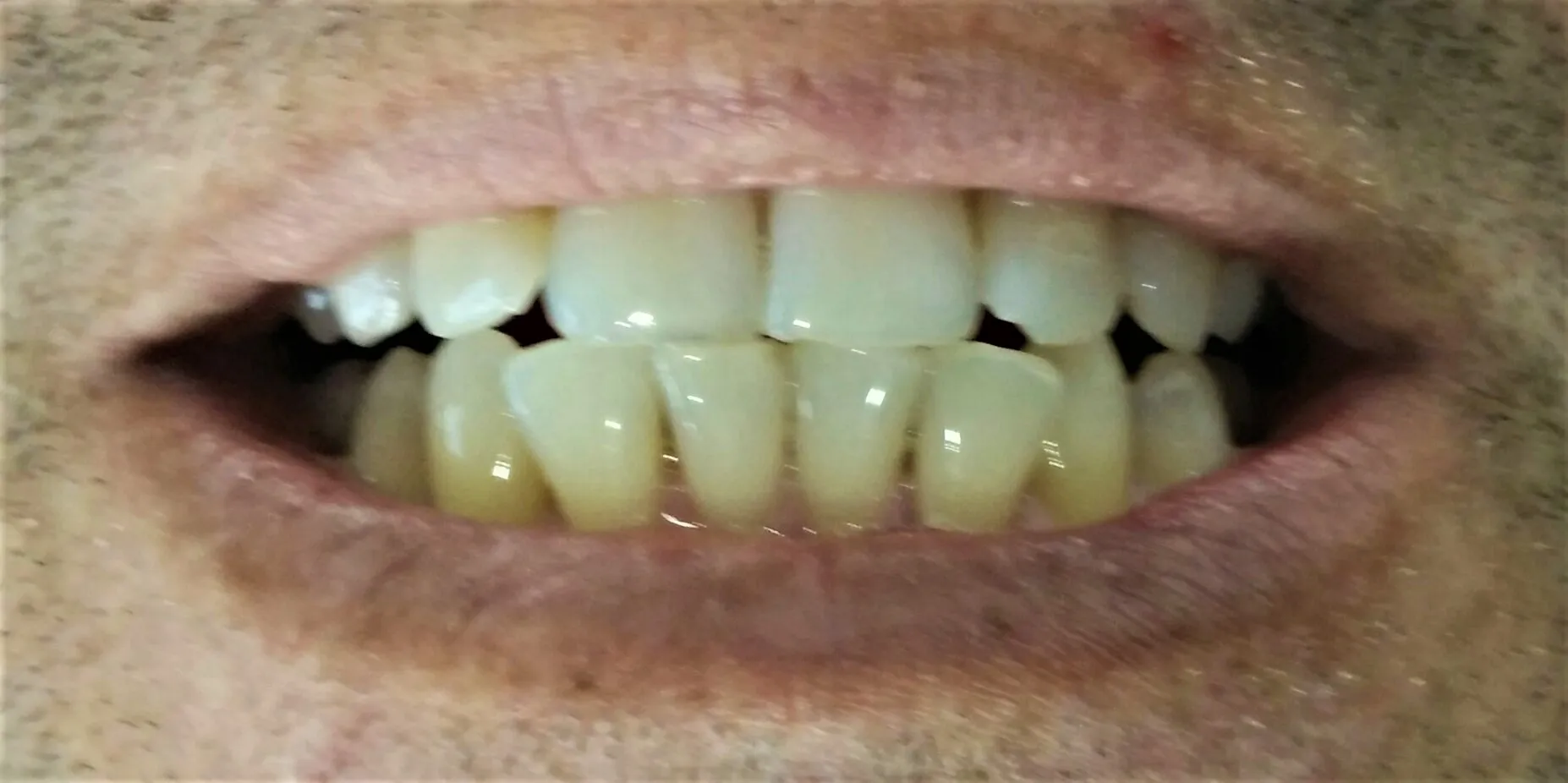 /img/25120-foods-to-avoid-teeth-whitening.webp