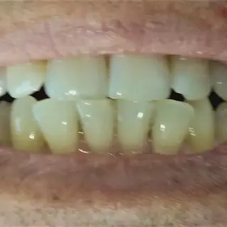 /img/25120-foods-to-avoid-teeth-whitening.webp