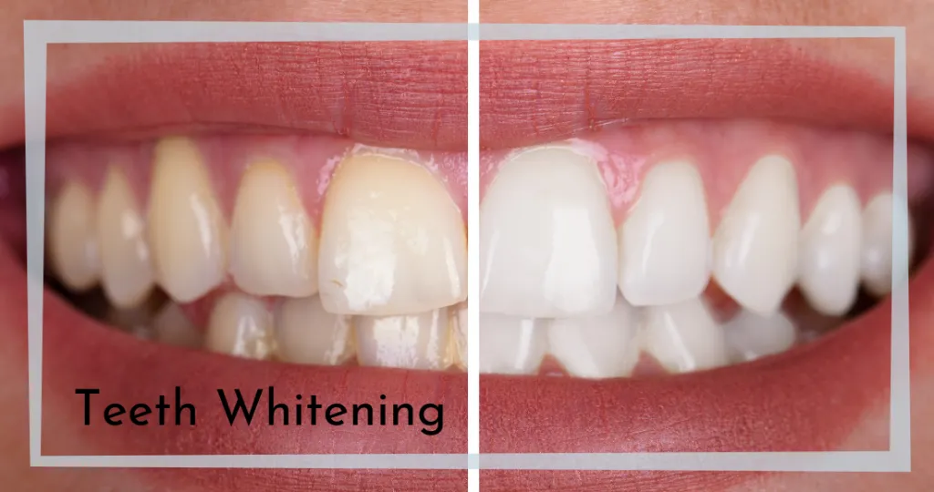 25120 healthy smile after whitening