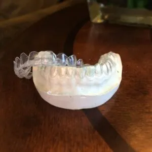 25120 teeth whitening gladstone procedure