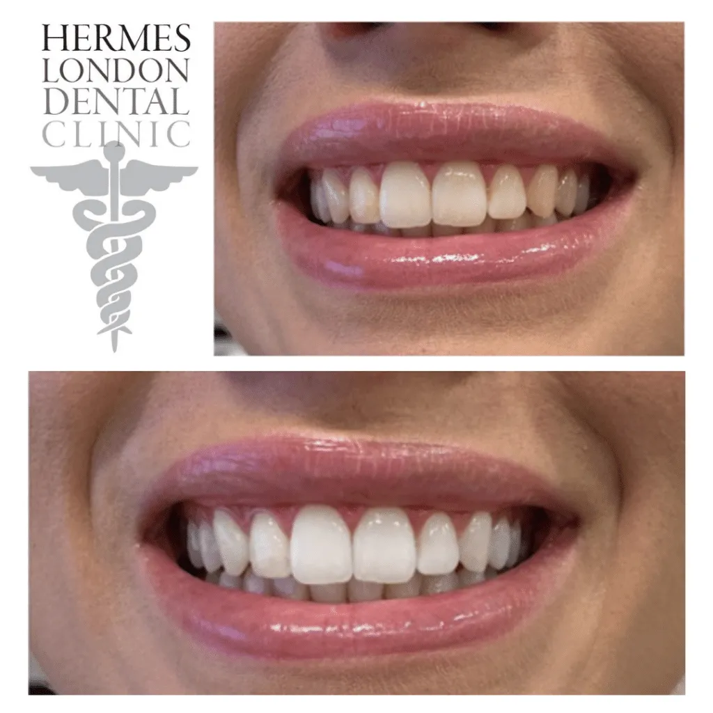 /img/25123-teeth-whitening-cost.webp