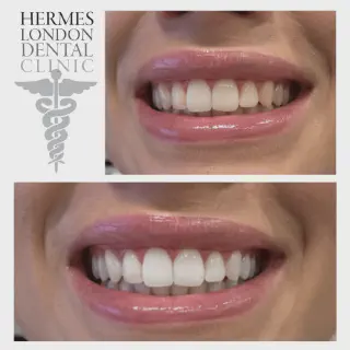 /img/25123-teeth-whitening-cost.webp