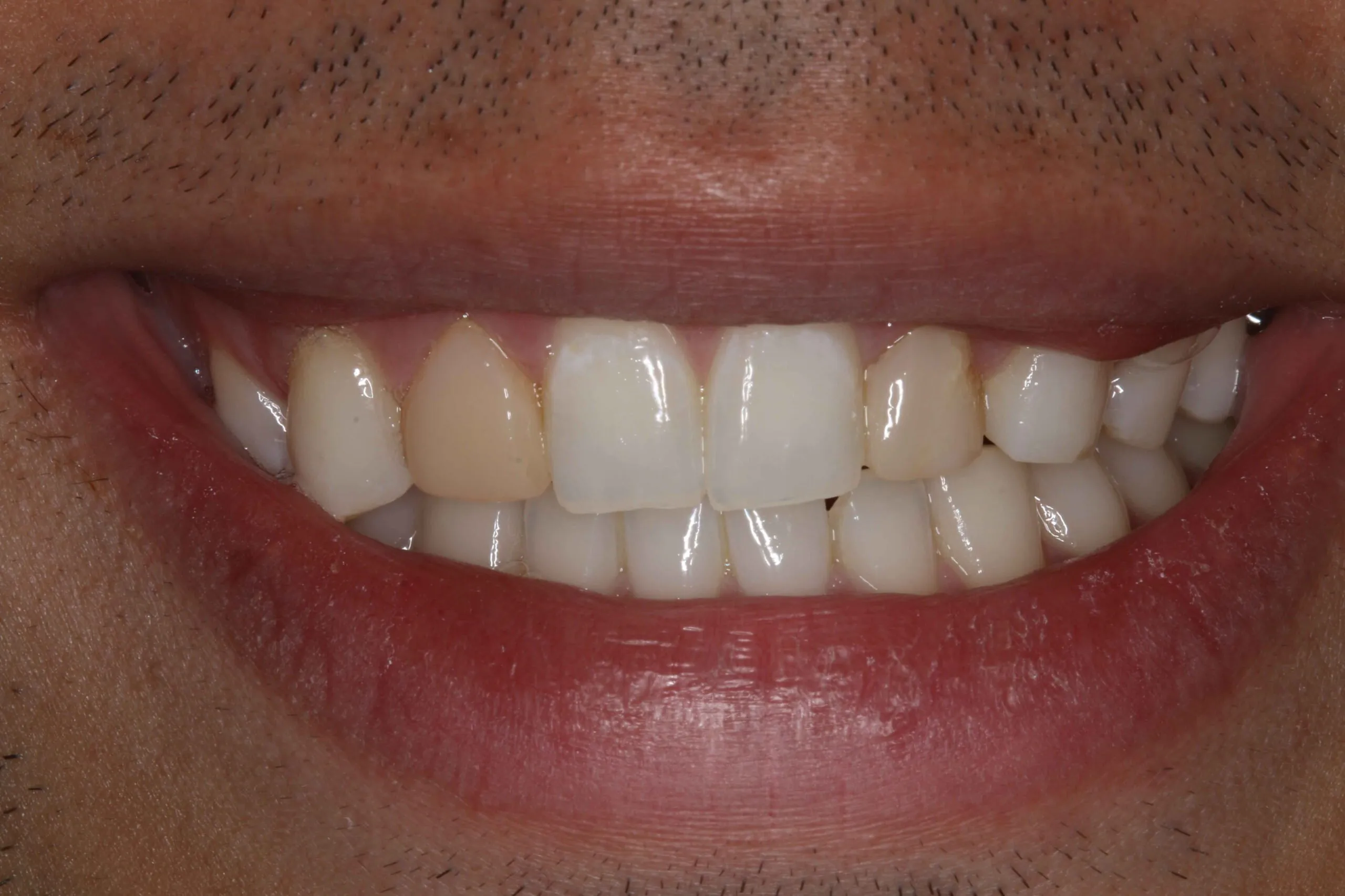 25125 composite bonding smile