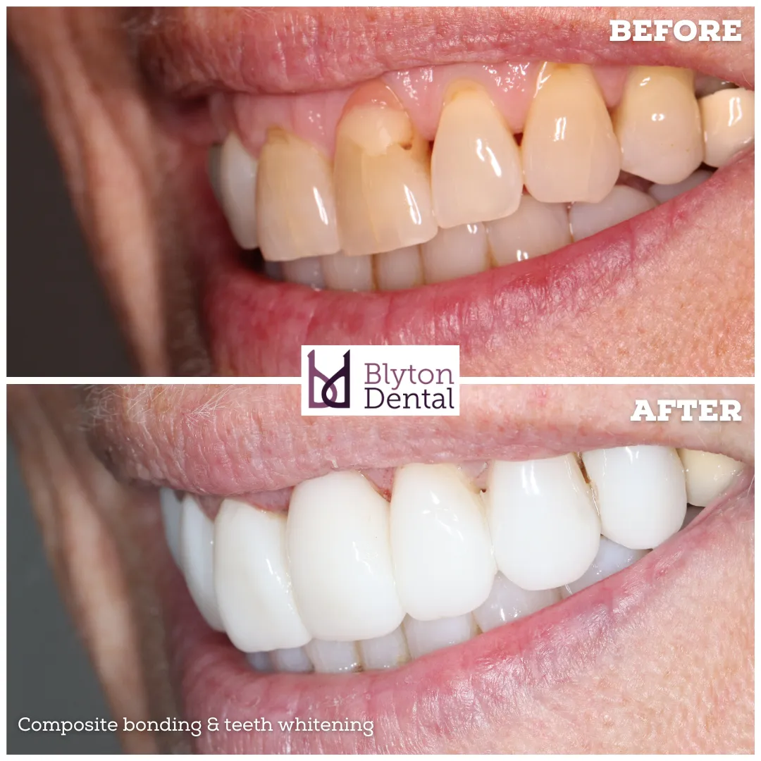 25125 composite bonding versatile