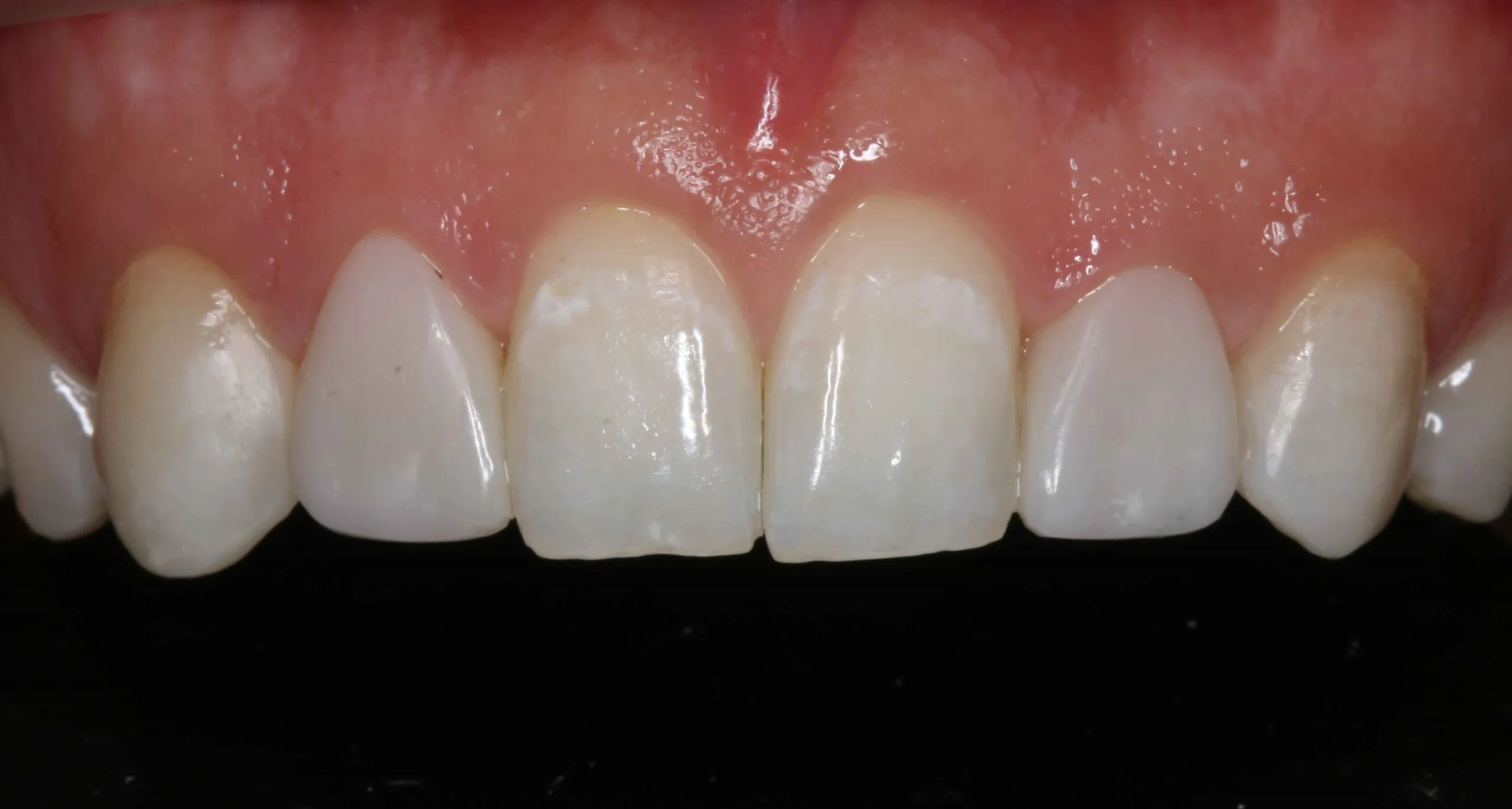 25125 teeth whitening cost