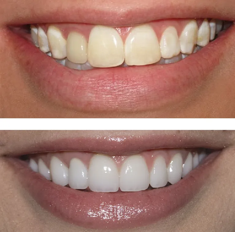 25130 professional teeth whitening