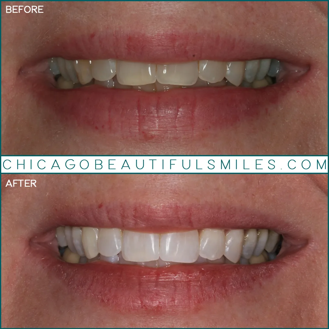 25130 teeth discoloration