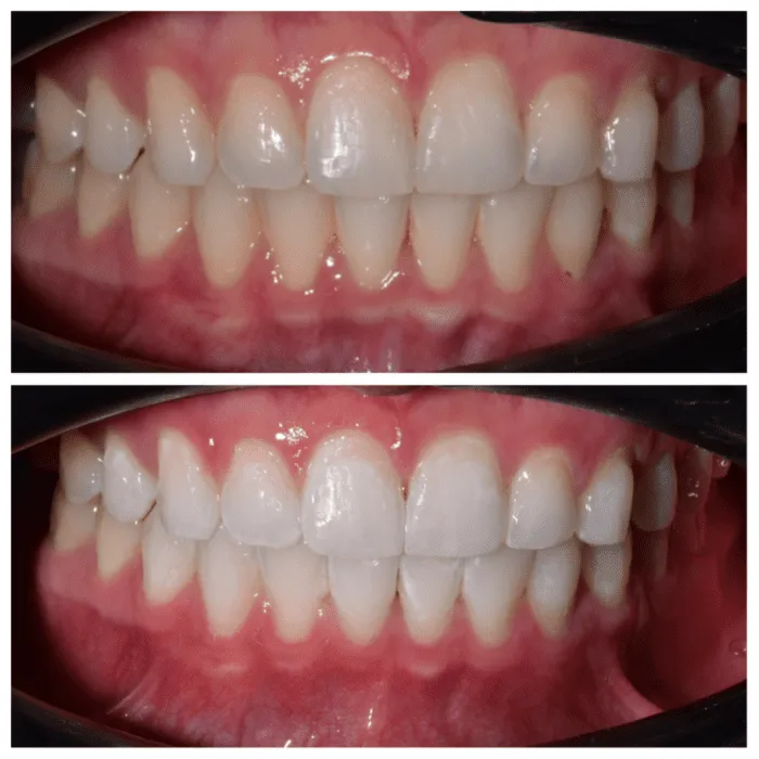 25134 zoom whitening tampa healthy teeth