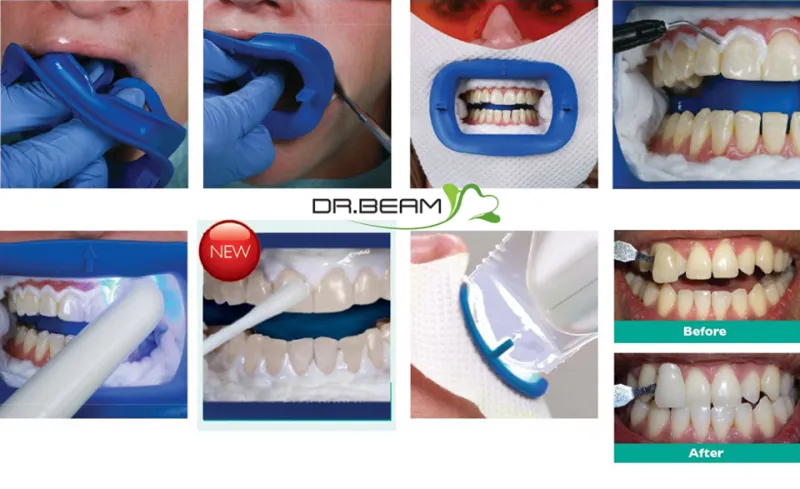 25134 zoom whitening tampa procedure
