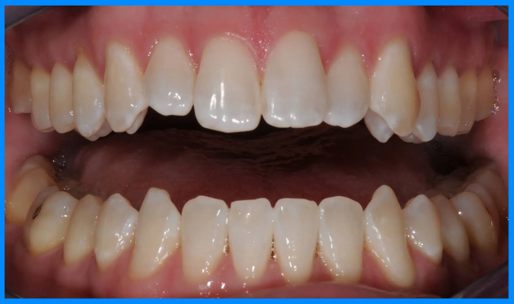 25134 zoom whitening tampa smile