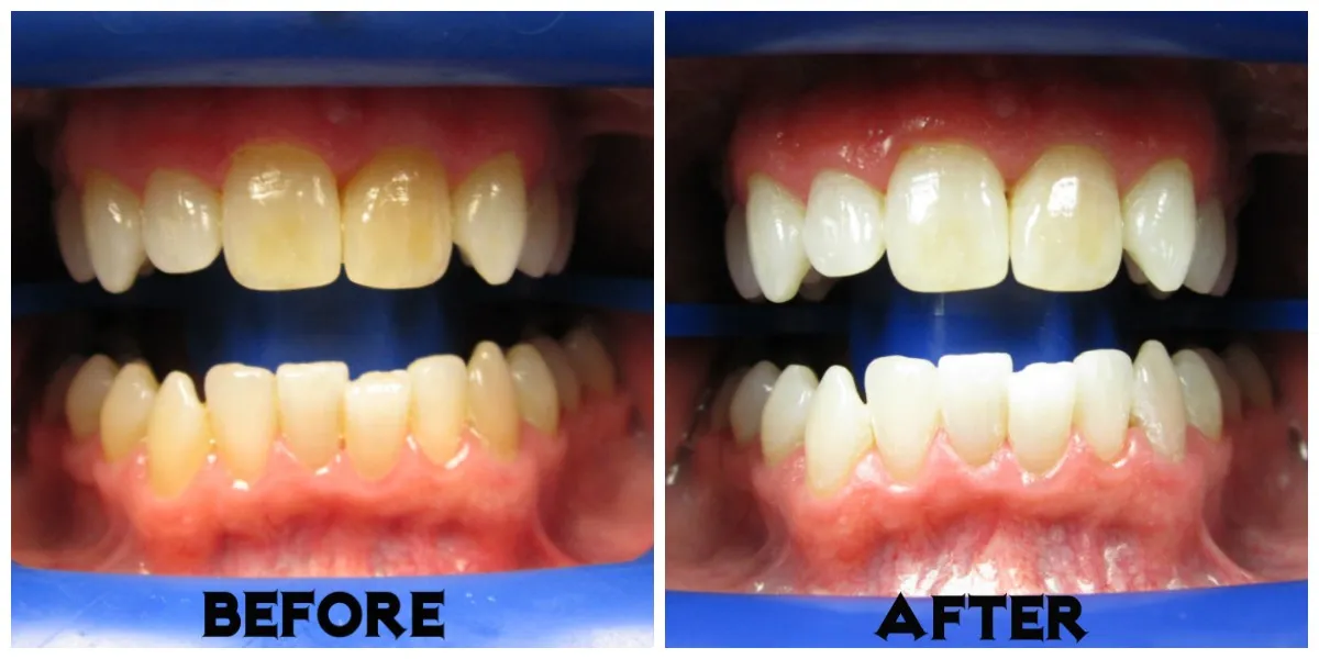 25139 teeth sensitivity zoom