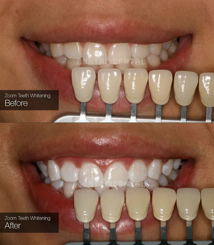 25139 zoom whitening process