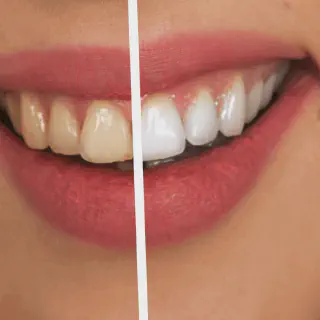 /img/25139-zoom-whitening-results.webp