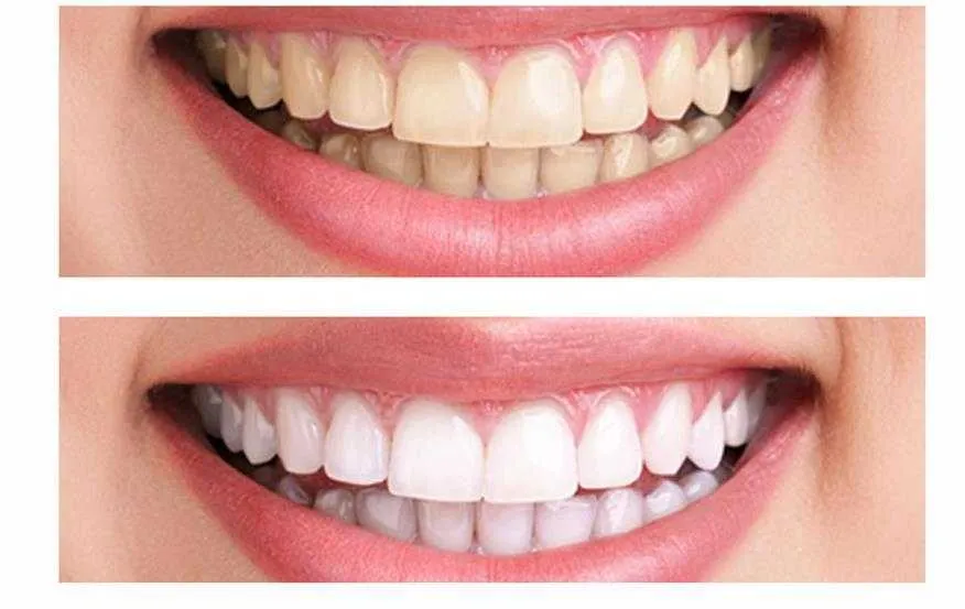 /img/25140-teeth-whitening-smile.webp