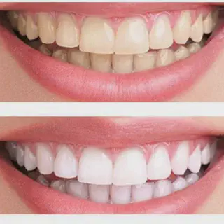 /img/25140-teeth-whitening-smile.webp