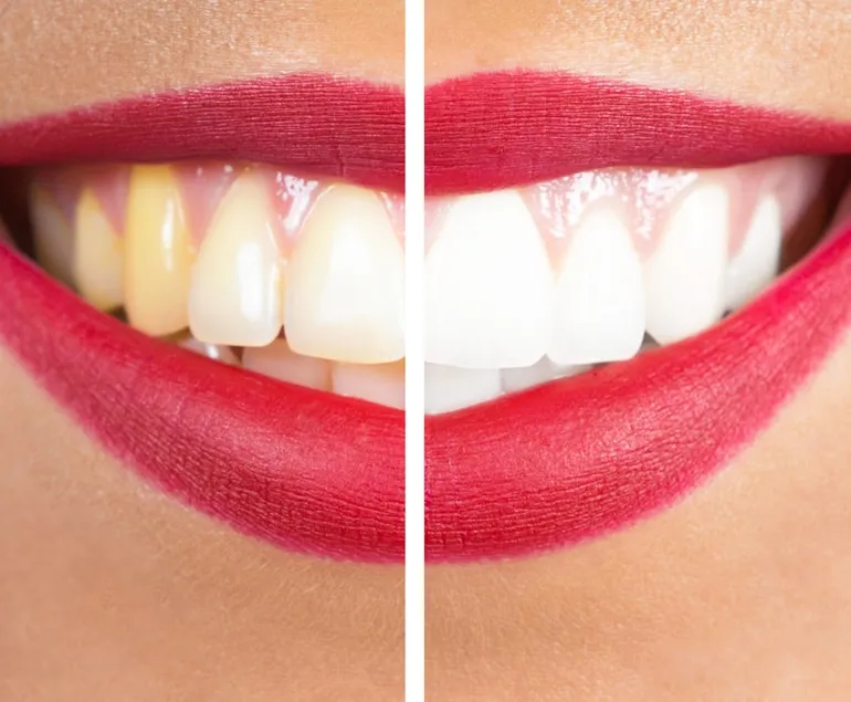 25141 teeth whitening huntsville al options