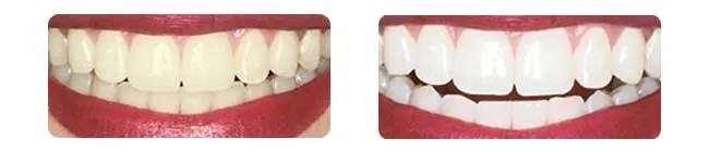 /img/25145-beautiful-white-teeth.webp