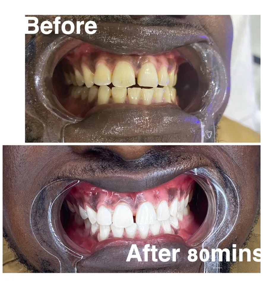 25145 foods to avoid teeth whitening