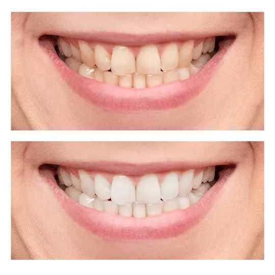 25146 teeth whitening malaysia image5