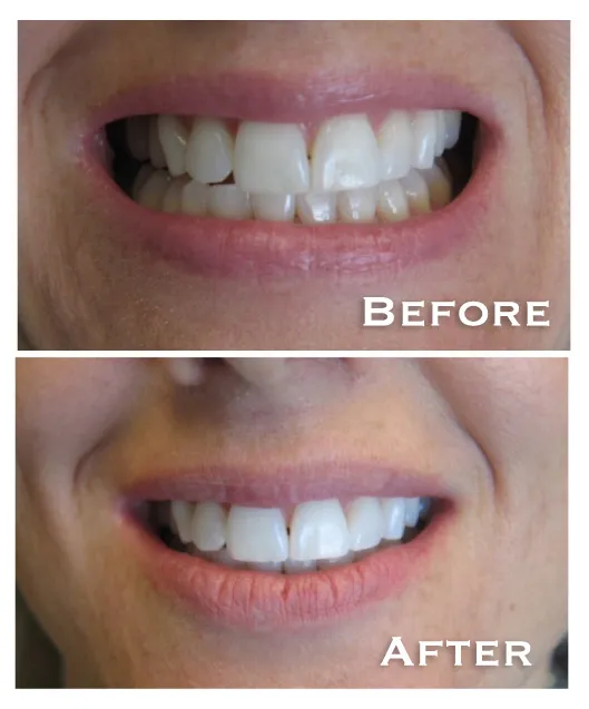 25152 in office teeth whitening