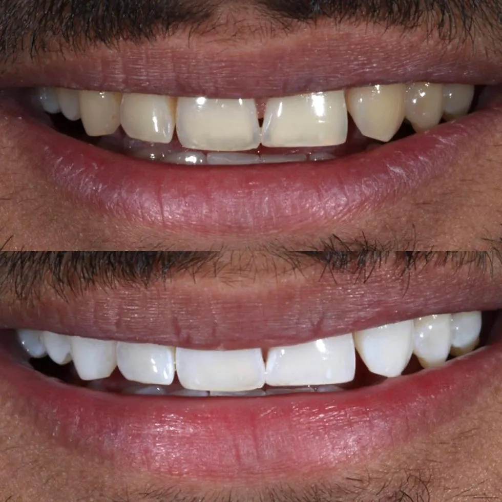 25152 teeth whitening before after