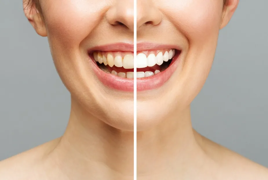 25152 types of teeth whitening