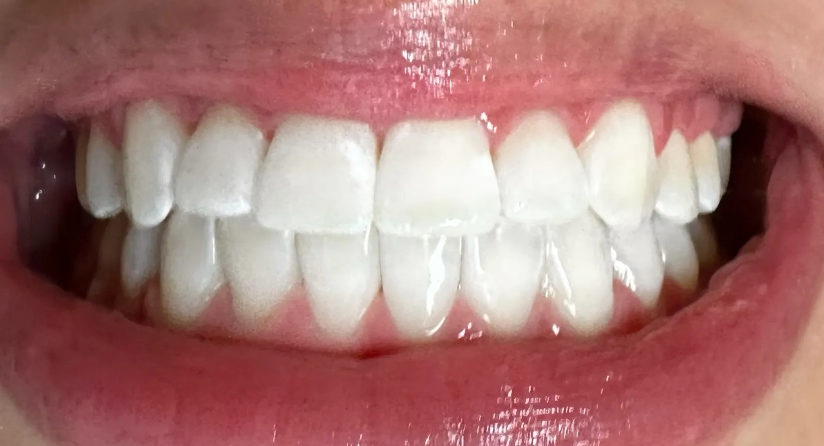 25155 healthy smile teeth whitening