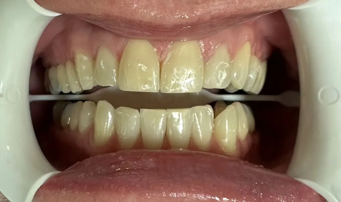 25155 long lasting white teeth