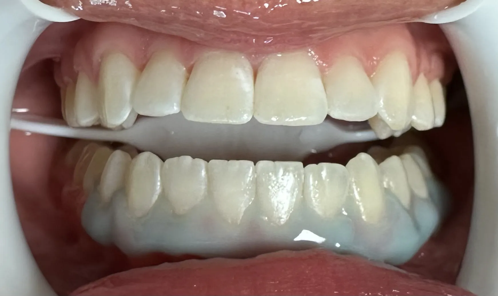 25155 professional teeth whitening