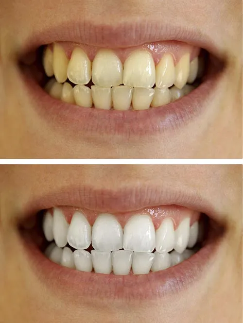 25155 teeth sensitivity treatment