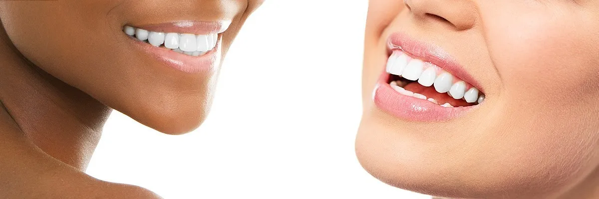 25156 teeth whitening marietta ga 1
