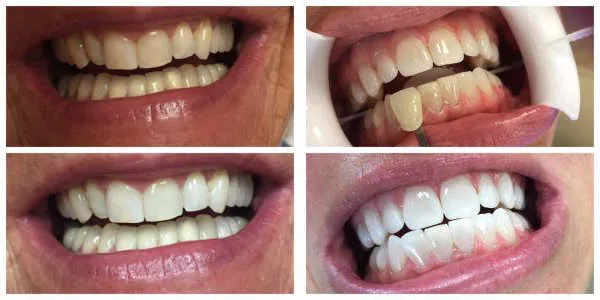 25156 teeth whitening marietta ga 6