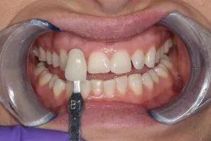25162 teeth whitening avoid foods 5