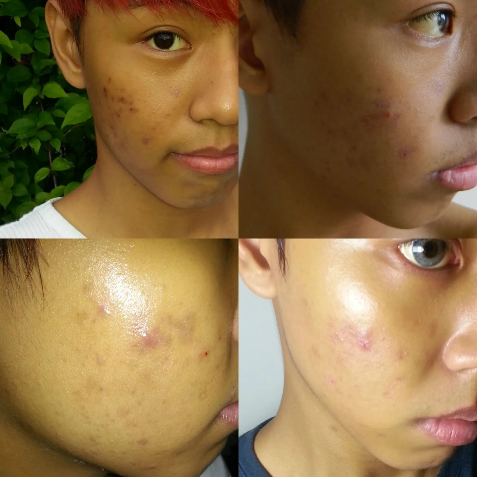 25164 pimple mark comparison