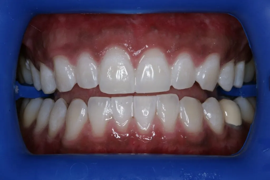 25165 teeth whitening methods