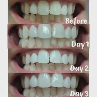 /img/25169-whitening-strip-smile.webp