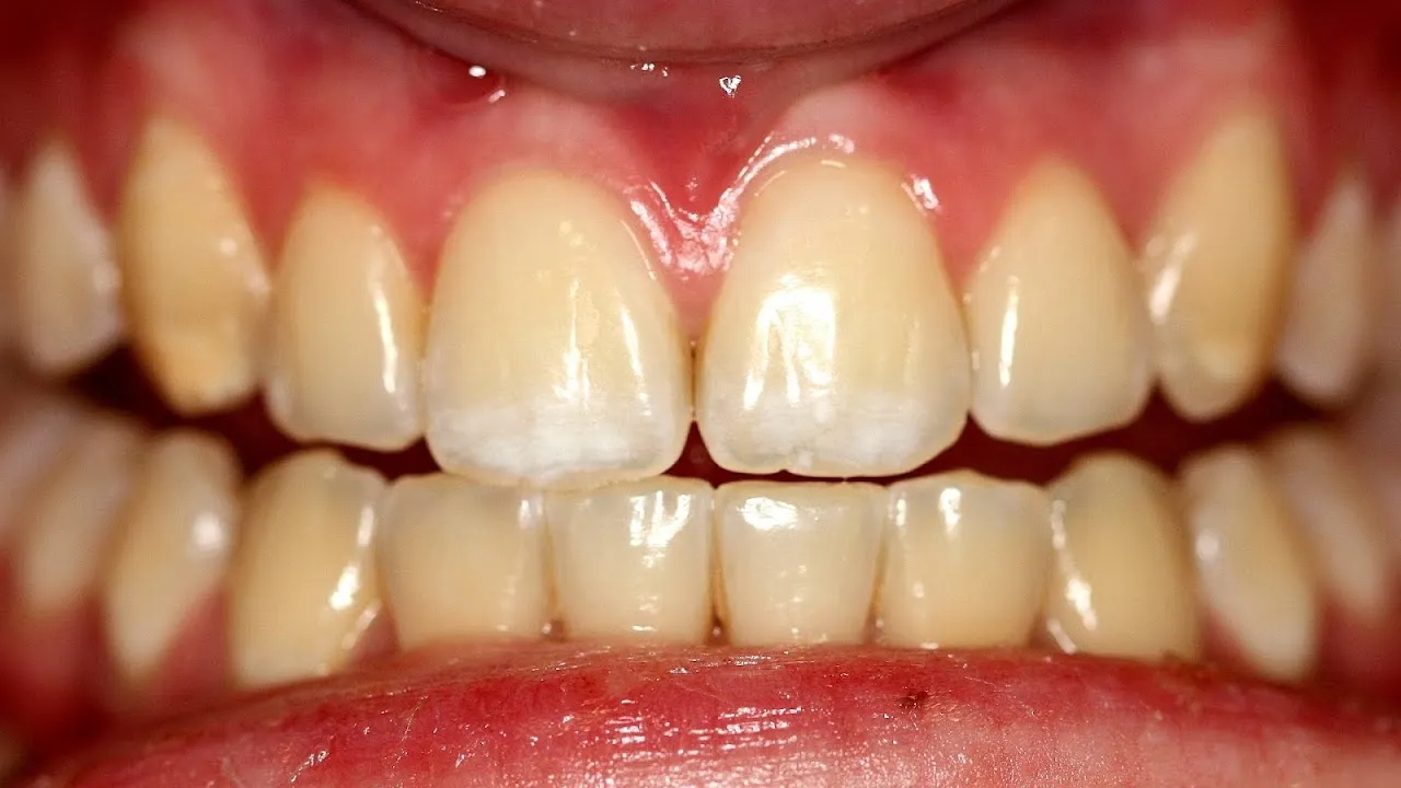 25177 dead tooth causes