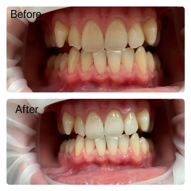 25177 internal bleaching procedure